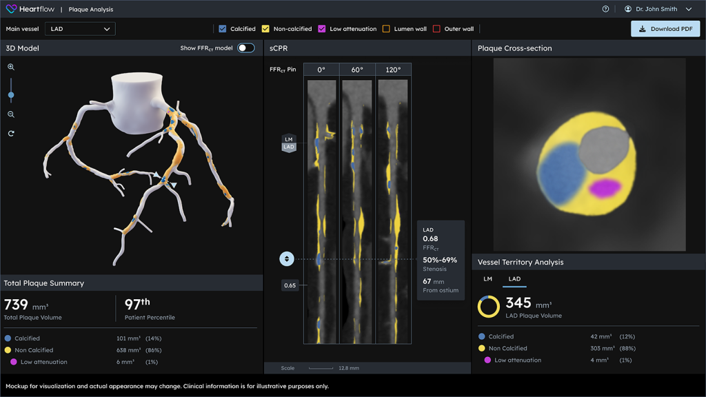 Advanced Plaque Analysis with Heartflow from MyCardiologist