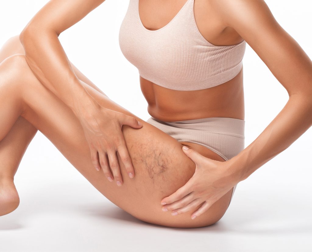 Miami Vericose Vein and Vascular Treatment from MyCardiologist